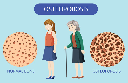 The Truth About Osteoporosis And How to Bulletproof Your Bone Health